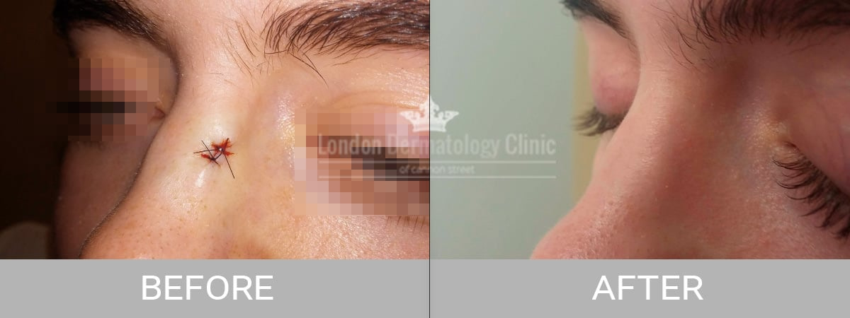 Before-After-cyst-removal Cyst Before and After Removal