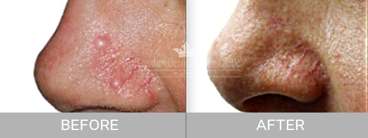 Before-After-mole-removal-surgery-1024x384@2x Mole Before After Removal