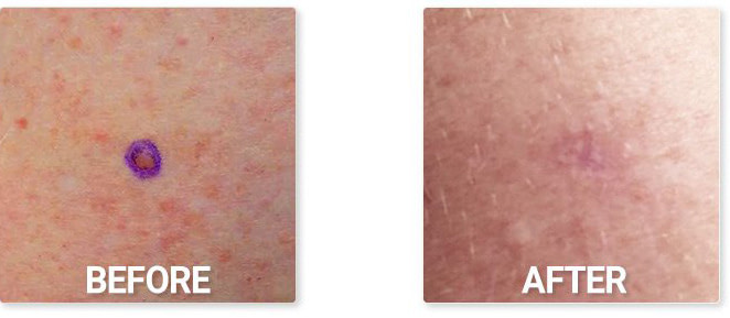 mole-removal-before-after-1 Mole Before After Removal