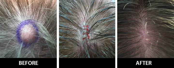 cyst-removal-surgery Cyst Removal
