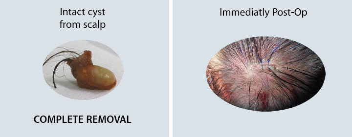 cyst_removal_scalp_surgery2 Cyst Scalp Removal