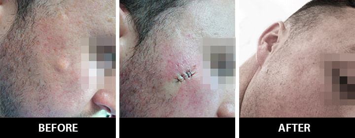 sebaceous-cyst-treatment Cyst Before and After