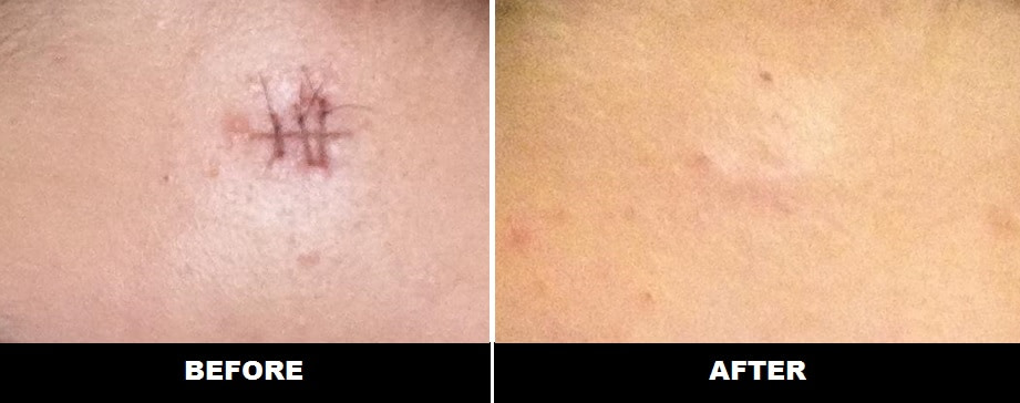 cyst-before-after Cyst Before and After
