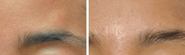 Lipoma Removal Before and After Lipoma Removal Before and After