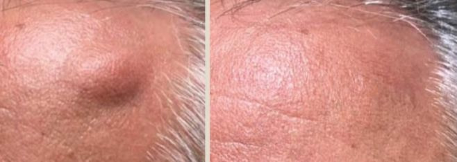 Lipoma Removal Before and Afetr 2 Lipoma Removal Before and After 2